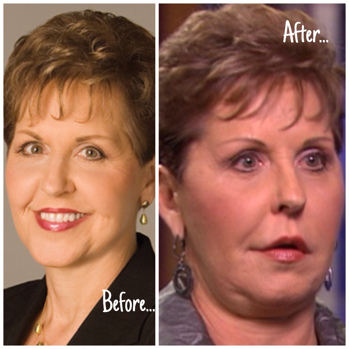 Joyce Meyer’s Face: The Plastic Surgery Reports.