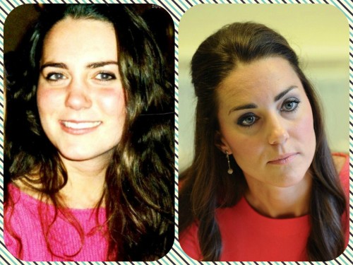 Kate Middleton Plastic Surgery